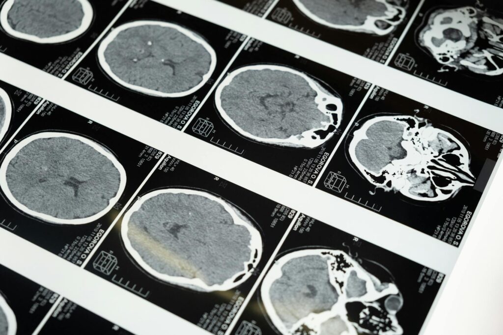 What is brain dump?